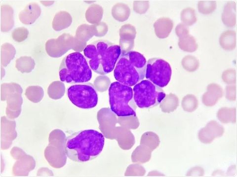 Myeloid Leukemia Basics: Learn the Causes, Signs, and Risk Factors