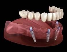 Dental Implants: Complete Guide to Basics, Benefits, Costs, and Long-Term Care Tips