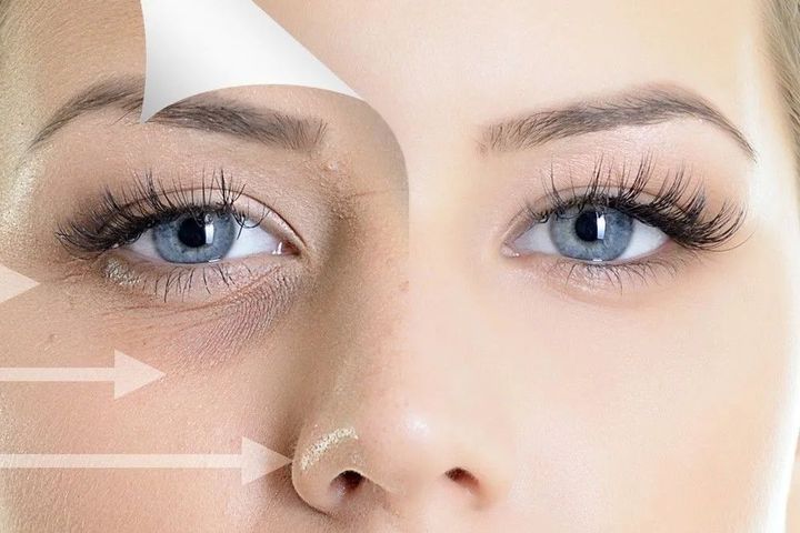 Discover Under Eye Skin Rejuvenation: Key Insights for Healthier, Smoother Skin
