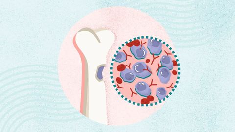 Myeloma Insights: Latest Advances in Diagnosis and Treatment Options