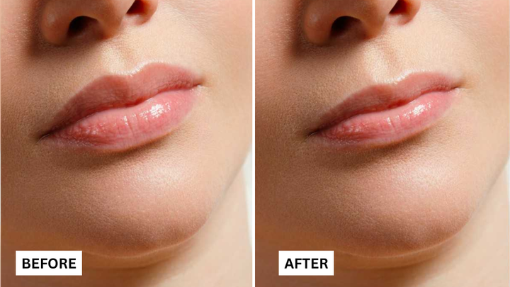Expert Tips to Understand Non-Surgical Lip Smoothing Treatments for Smooth Lips